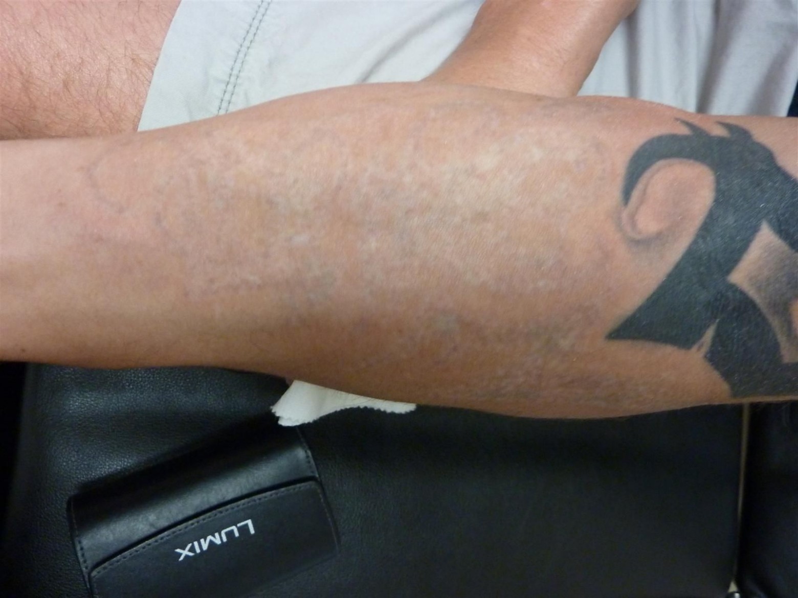 Tattoo Removal - Eshaan Laser and Skincare Medical Spa
